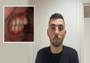 Kai Orley's teeth, pictured here two-and-a-half years after he started his treatment, started sticking out AFTER he got braces.