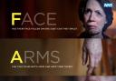 CAMPAIGN: The NHS has a “FAST” campaign to raise awareness about strokes, and action to take to help patients