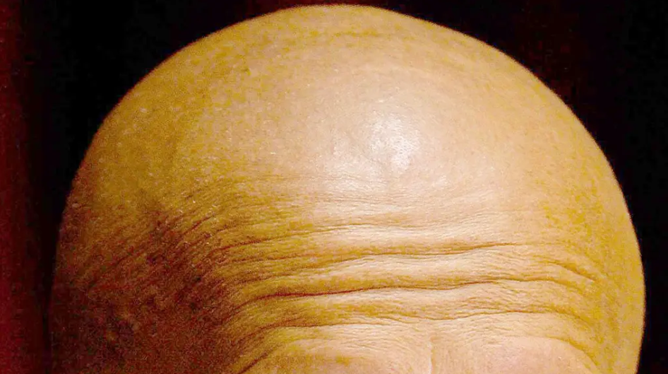 Calling man bald is sexual harassment, panel of balding judges rule