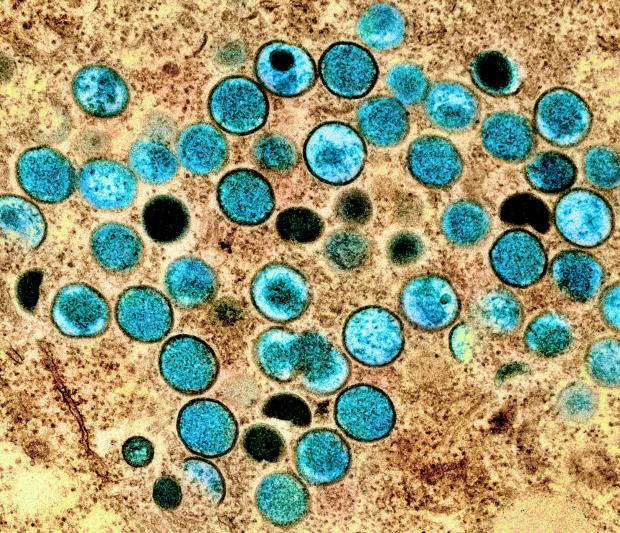 The Northern Echo: A colorised transmission electron micrograph of monkeypox particles (teal) found within an infected cell (brown), cultured in the laboratory. Picture: PA MEDIA 