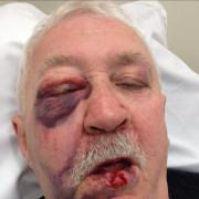 Ronald Jackson with heavy facial injuries following pub assault in April 2018