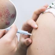 The shingles vaccine will be offered to another 900,000 from September