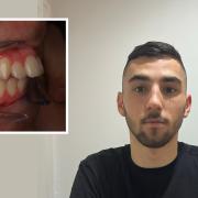 Kai Orley's teeth, pictured here two-and-a-half years after he started his treatment, started sticking out AFTER he got braces.