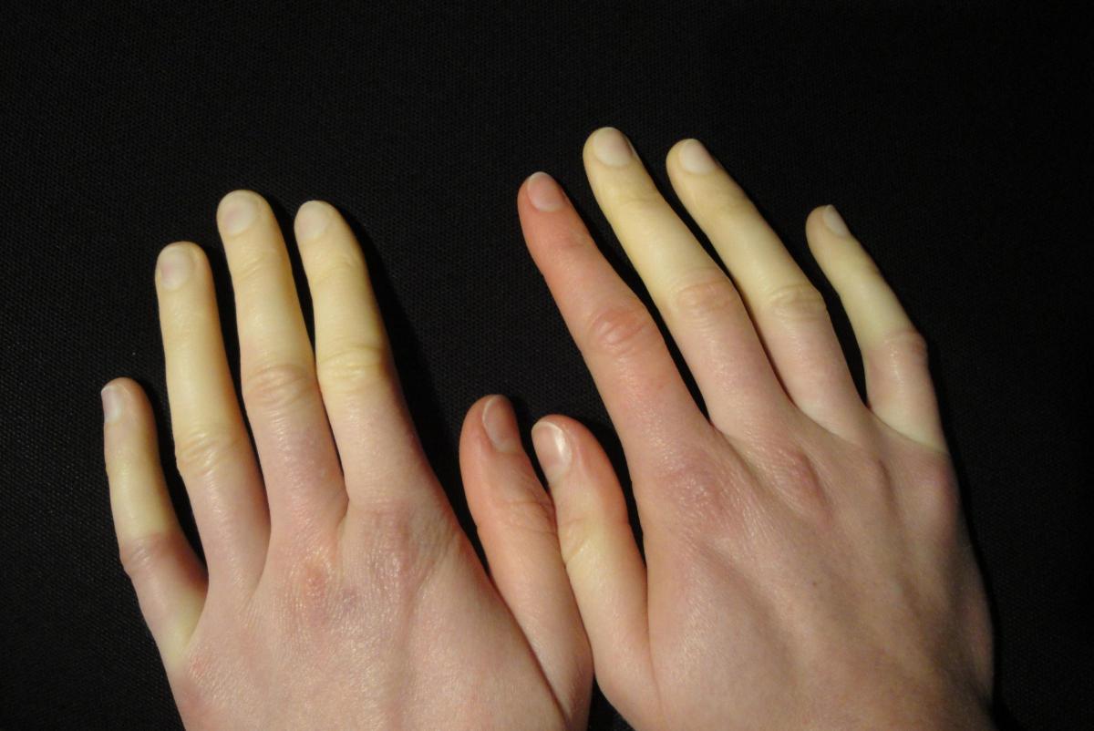 Image result for raynaud's hands
